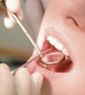 снятие зубного камня ультразвуком